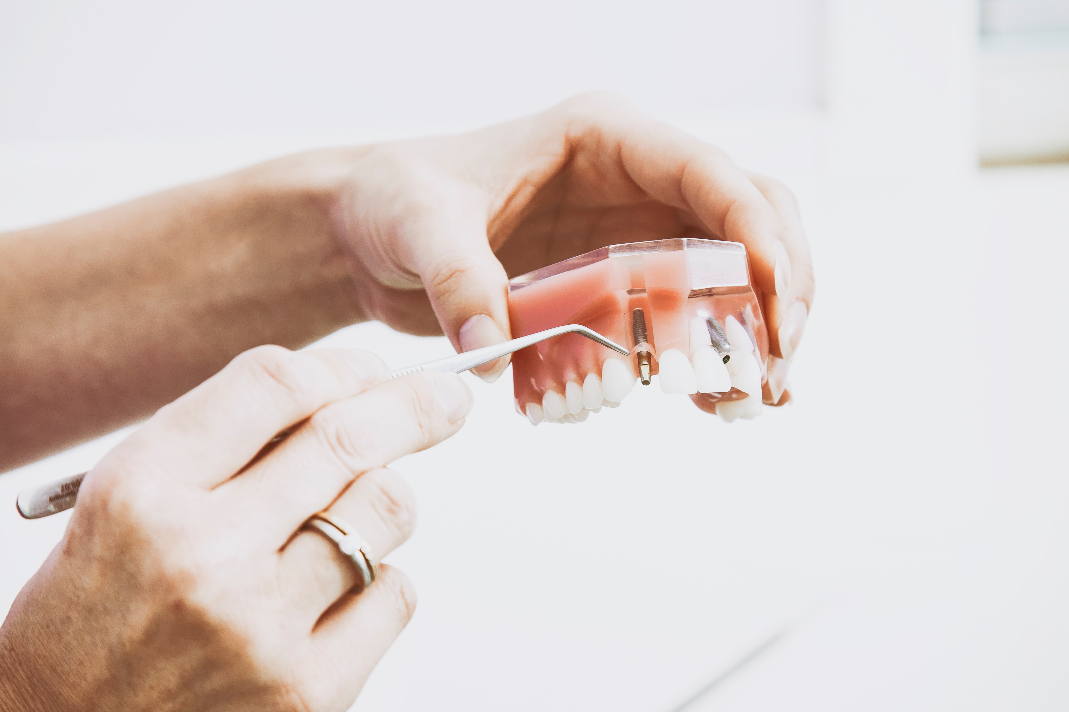 implanturi-dentare
