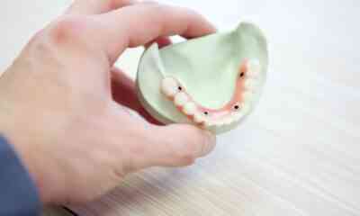 implant dentar