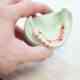 implant dentar